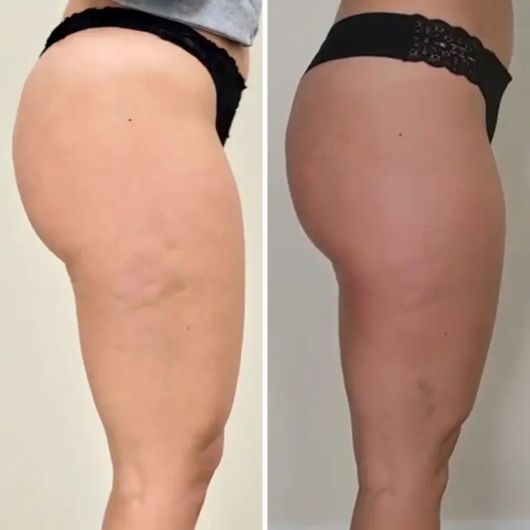 before and after endospheres therapy image of the legs