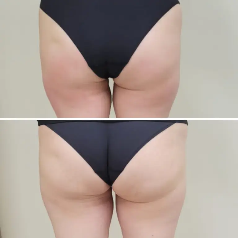 before and after endospheres therapy image hips area