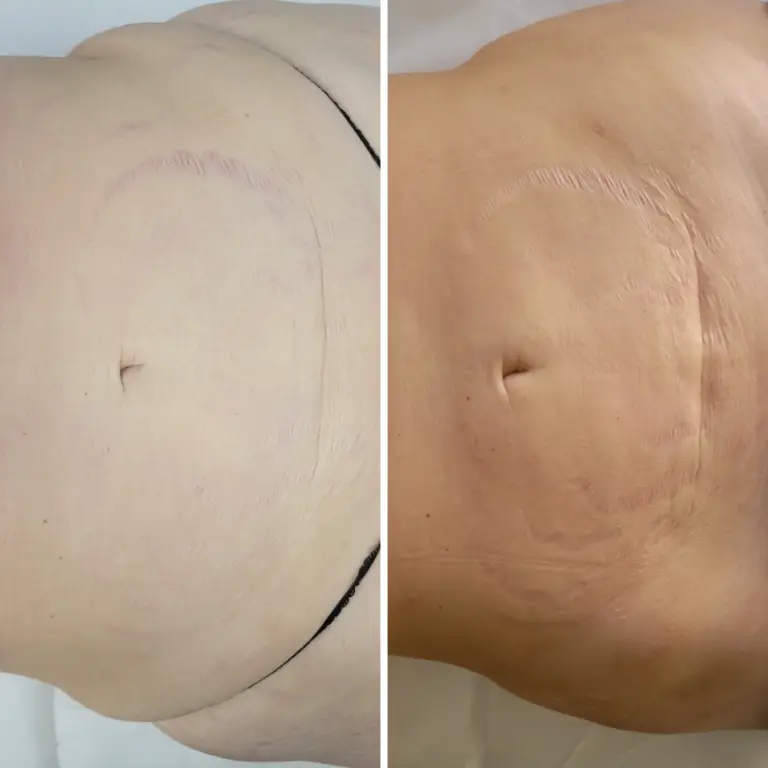 before and after endospheres therapy image in the tummy area