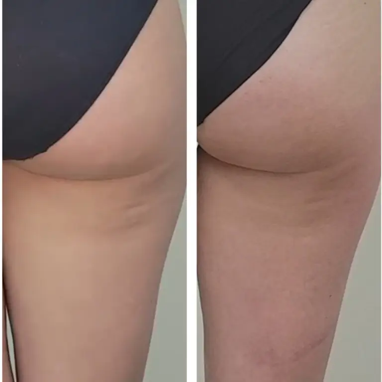 before and after endospheres therapy image of the legs